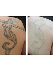 Tattoo Removal - Wharf clinic
