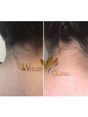 Soprano Laser Hair Removal - Wharf clinic