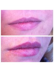 Lip Augmentation - Abby Stacey - Advanced Skin Treatment - Bedlington