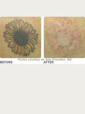 Cannelle Beauty - Oxford - tattoo removal
