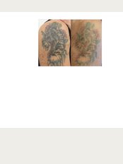 Laser Tattoo Removal Clinic Croydon & London - 56 Shirley Rd, Croydon, London, CR0 7EP, 