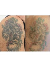 Laser Tattoo Removal Clinic Croydon & London - 56 Shirley Rd, Croydon, London, CR0 7EP,  0