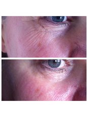Facial Rejuvenation - Abby Stacey - Advanced Skin Treatments - On Tyne
