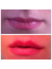 Lip Augmentation - Abby Stacey - Advanced Skin Treatments - On Tyne