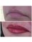 Abby Stacey - Advanced Skin Treatments - On Tyne - Semi permanent lips 