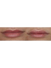 natural lip enhancement  - Wish Skin Clinic Live Life Young