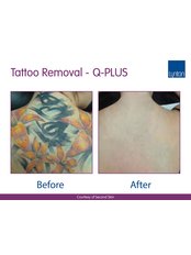 Tattoo Removal - Wish Skin Clinic Live Life Young