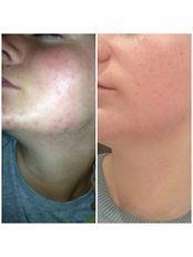 Acne Treatment - Samsara Skin Clinic