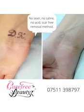 Tattoo Removal - Carefree Beauty Permanent Makeup