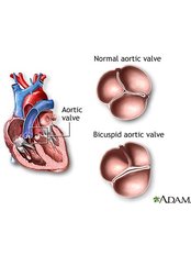Aortic Valve Replacement - Surgical Saving
