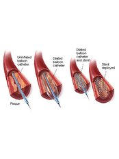 Coronary Catheterization and Stenting - Bharath Cardiovascular Institute