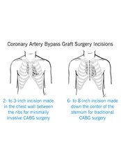 Coronary Artery Bypass Surgery - Bharath Cardiovascular Institute
