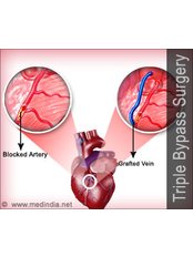 Heart Bypass - Bharath Cardiovascular Institute
