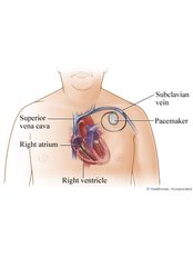 Pacemaker - Bharath Cardiovascular Institute