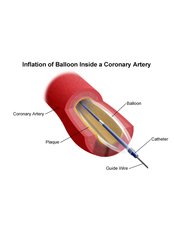 Coronary Angioplasty - Bharath Cardiovascular Institute