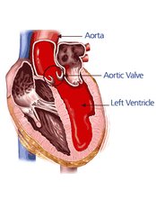 Aortic Valve Replacement - Bharath Cardiovascular Institute