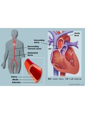 Aortic Valve Replacement - Child Heart Treatment