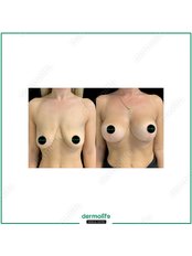 Breast Lift - Dermolife