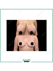 Breast Reduction - Dermolife