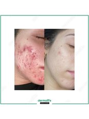 Acne Treatment - Dermolife