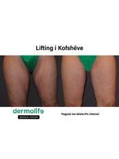 Thigh Lift - Dermolife