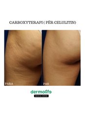 Carboxytherapy - Dermolife
