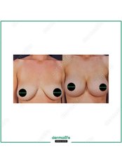 Breast Agumentation - Dermolife