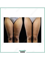 Thigh Liposuction - Dermolife