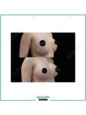 Breast Implant Revision - Dermolife