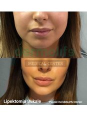 Buccal Fat Removal - Dermolife