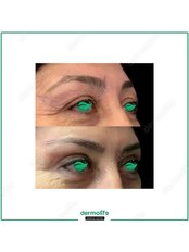Eyelid Surgery (Blefaroplasty) - Dermolife