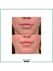 Lip Lift - Dermolife