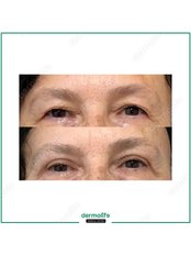 Eyelid Surgery (Blefaroplasty) - Dermolife