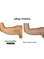 Arm Lift - Dermolife