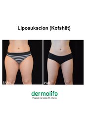 Liposuction - Dermolife