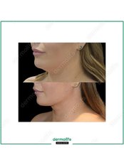 Neck Liposuction - Dermolife