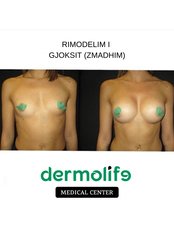 Breast Agumentation - Dermolife
