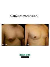 Gynecomastia - Dermolife