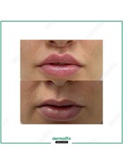 Lip Lift - Dermolife
