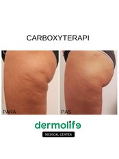 Carboxytherapy - Dermolife