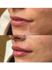 Lip Filler - Dr. Gera Tagani Clinic