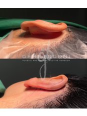 Otoplasty - Dr. Gera Tagani Clinic