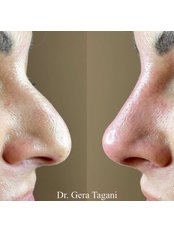 Non-Surgical Nose Job - Dr. Gera Tagani Clinic