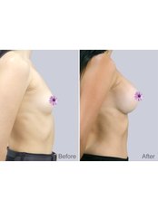 Breast Augmentation - Keit Clinic