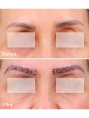 Eyebrow Hair Transplant - Keit Clinic
