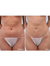 Liposuction - Keit Clinic