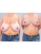 Breast Reduction - Keit Clinic