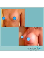 Breast Implants - Dr Zuccardi Santiago