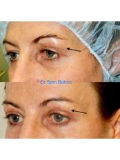 Eyelid Surgery - Lavida Cosmetic Medicine- Greenacre