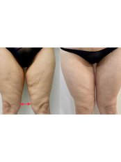 Thigh Liposuction - Lavida Cosmetic Medicine- Greenacre